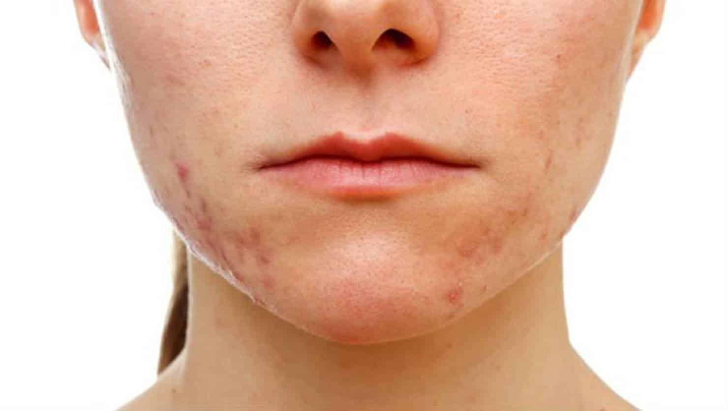 Cuidado! Estes ingredientes podem causar acne