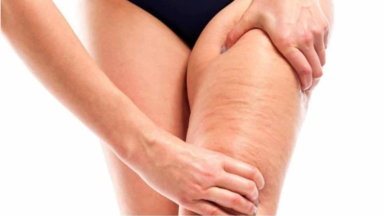 Quais são os melhores tratamentos para reduzir celulite nas pernas?