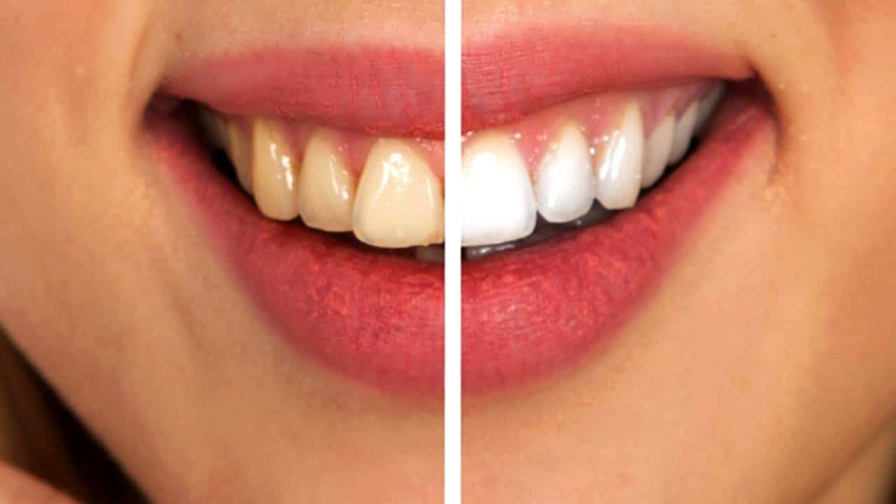 3 dicas para clarear os dentes naturalmente em casa