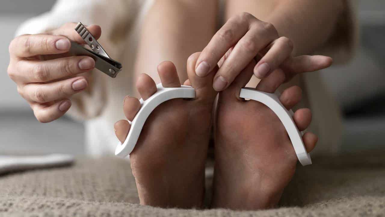 Diga adeus aos fungos nas unhas com estes 3 remédios caseiros simples
